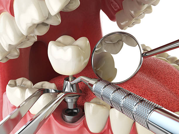 Best Chipped Tooth Repair Near Me  in Picayune, MS